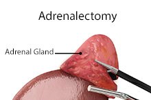 Adrenalectomy