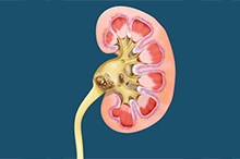 adrenal gland kidney stones